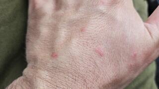 מכת פשפשים מאיימת על בריאות המילואימניקים  במגננים