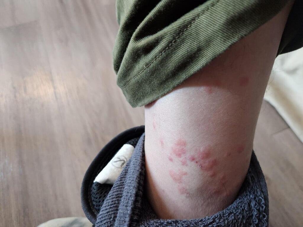 מכת פשפשים מאיימת על בריאות המילואימניקים  במגננים