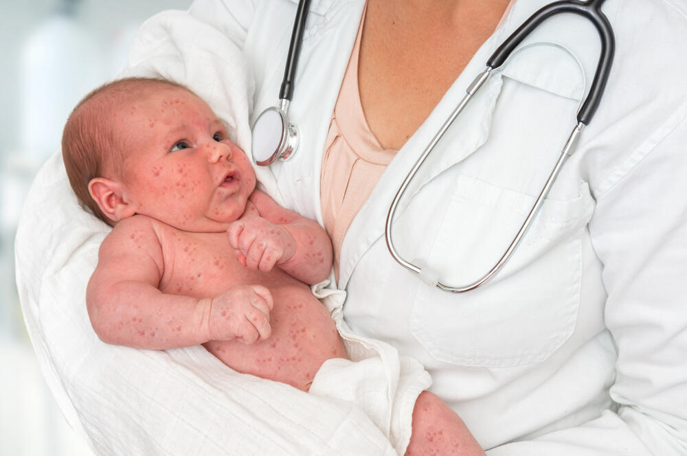 A measles-stricken infant (Photo: Shutterstock) תינוק חולה חצבת