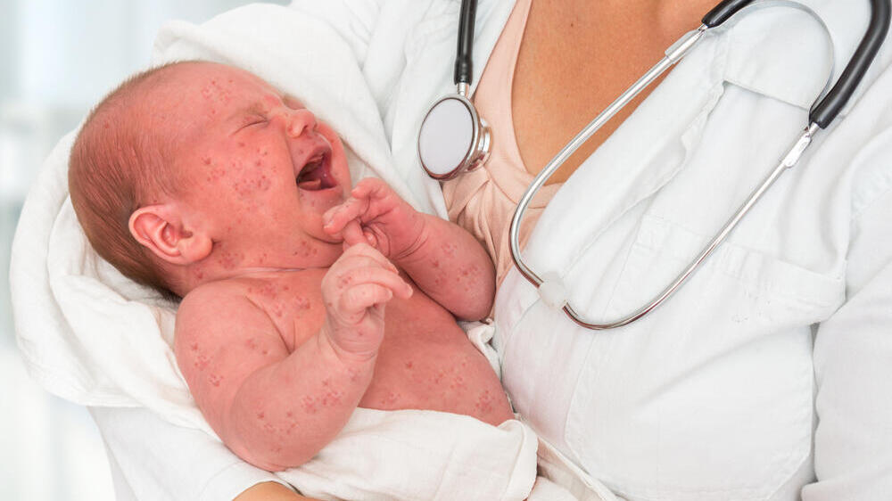 A baby infected with measles (Photo: Shutterstock) תינוק חולה חצבת