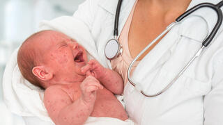 תינוק חולה חצבת