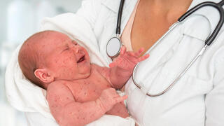 תינוק חולה חצבת