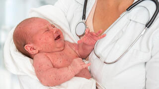 תינוק חולה חצבת