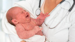 תינוק חולה חצבת