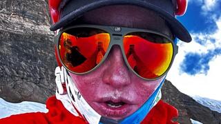 דניאל וולפסון עם כוויות קור על הפנים לאחר ההעפלה לפסגה