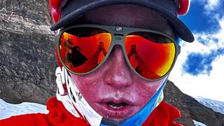 דניאל וולפסון עם כוויות קור על הפנים לאחר ההעפלה לפסגה