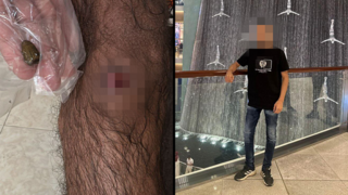 חור הקליע שנשאר ברגלו של תושב טמרה כ-9 חודשים