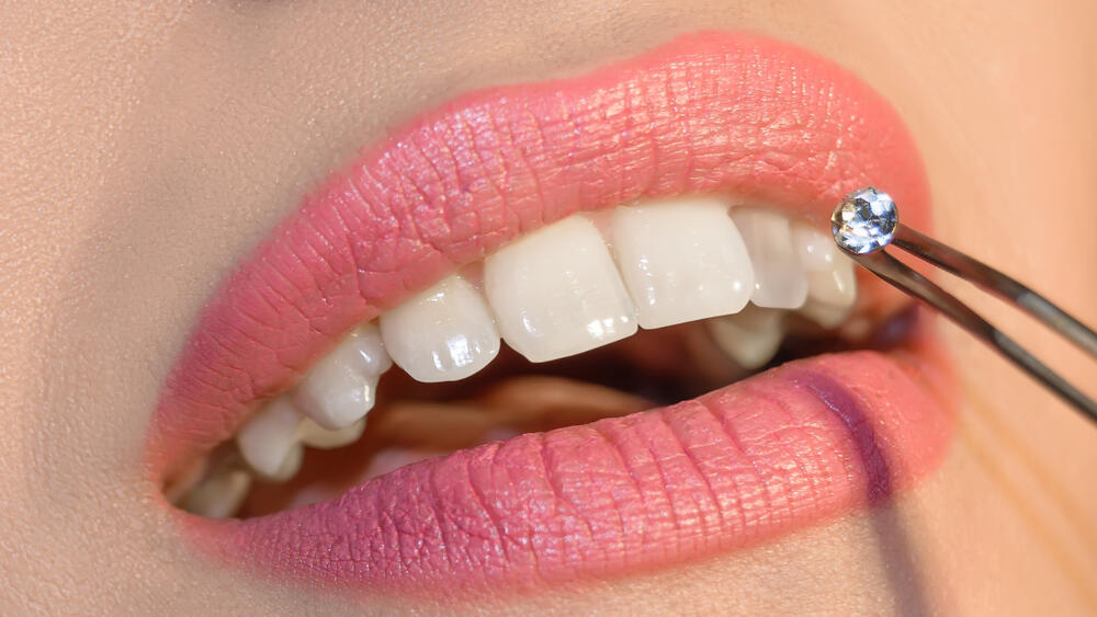 Фото: shutterstock תכשיטי שיניים