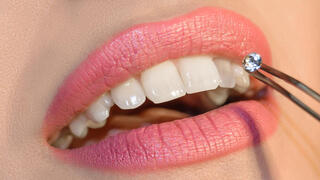 תכשיטי שיניים