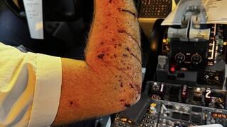 היד הפצועה של הטייס