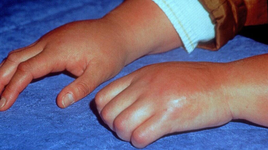 Early-stage CRPS (Photo: Wikipedia) תסמונת כאב אזורי מורכב