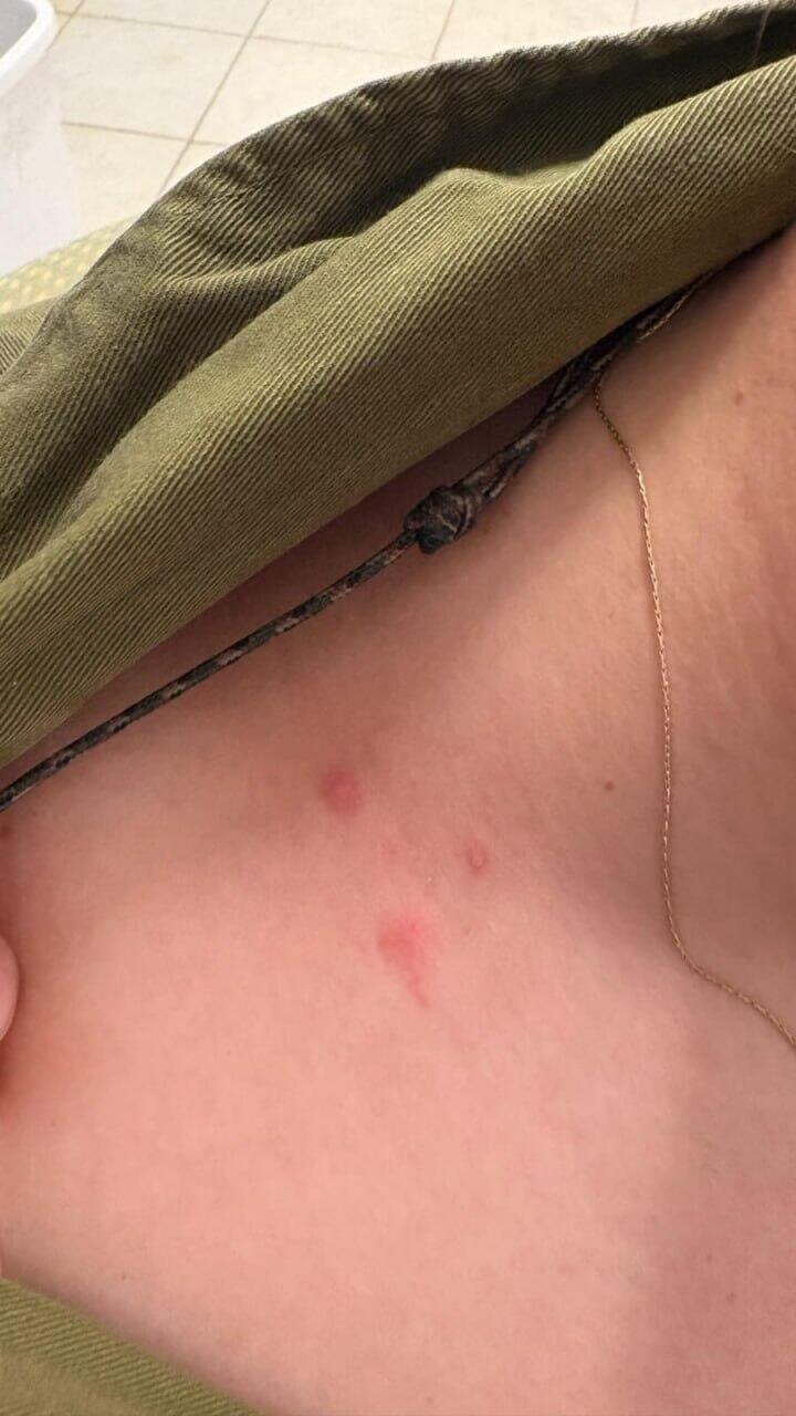 Bedbug bites on soldier in Michve Allon military base עקיצות הפשפשים על חיילים מבסיס מחו״ה אלון