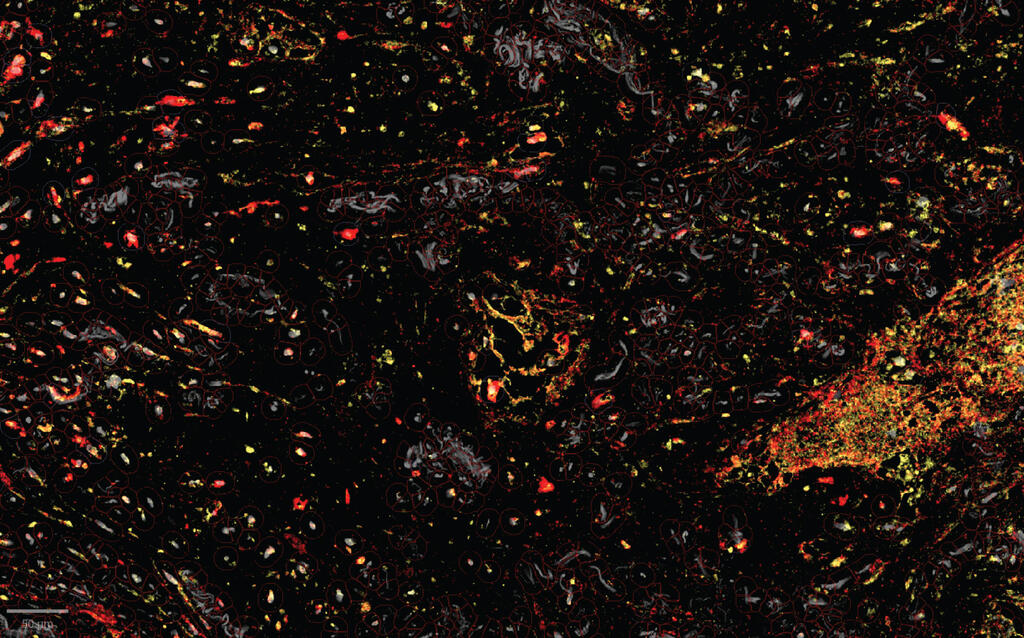 Human lung cancer tissue under a microscope; the enzymes (yellow) that unmask the immune-activating molecules are found near the TREM2 receptors (red) of the tumor-assisting macrophages; this targeted unmasking can prevent damage to healthy tissues Human lung cancer tissue under a microscope. The enzymes (yellow) that unmask the immune-activating molecules are found near the TREM2 receptors (red) of the tumor-assisting macrophages. This targeted unmasking can prevent damage to healthy tissues