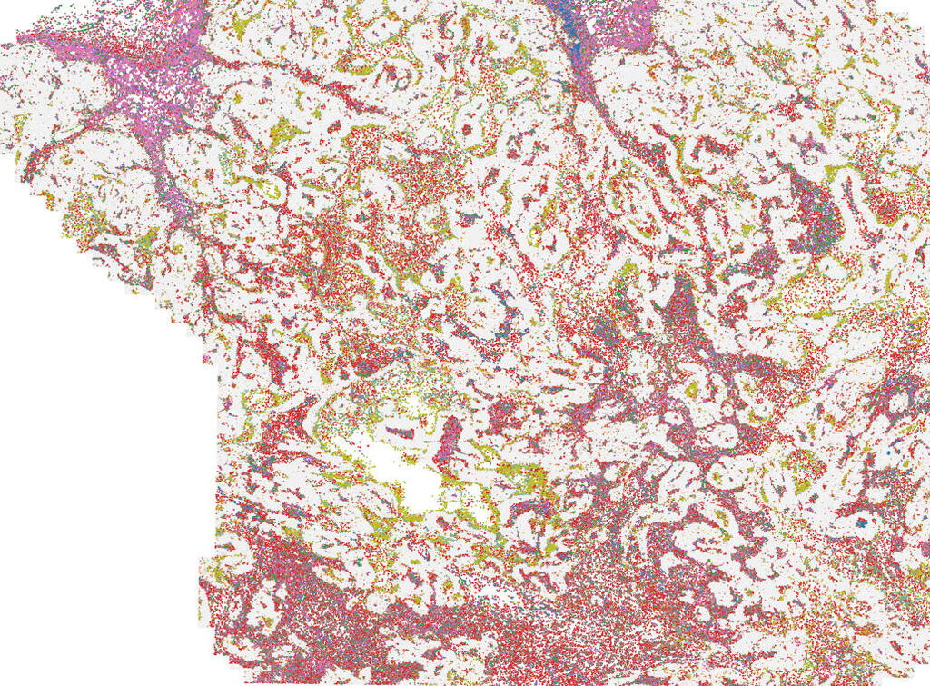 The mapping of spatial immune architecture in human breast cancer tissue (tumor cells are in gray) reveals close proximity of macrophages (brown-orange) and exhausted killer cells (light pink-purple) The mapping of spatial immune architecture in human breast cancer tissue (tumor cells are in gray) reveals close proximity of macrophages (brown-orange) and exhausted killer cells (light pink-purple)