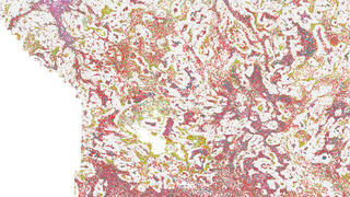 The mapping of spatial immune architecture in human breast cancer tissue (tumor cells are in gray) reveals close proximity of macrophages (brown-orange) and exhausted killer cells (light pink-purple)