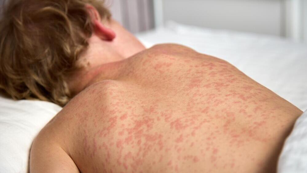 'There is no reason for a 1- or 2-year-old child to die of measles when we have such a good vaccine' (Photo: Shutterstock) חצבת