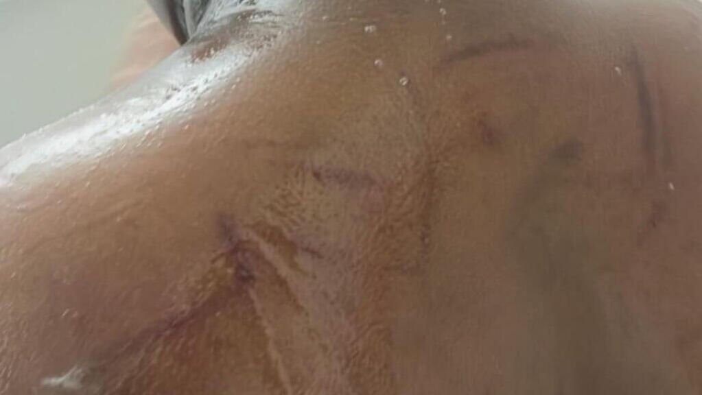 Следы от издевательств на теле мальчика ילד בן 11 על הרצף האוטיסטי שעובר התעללות בבית הספר