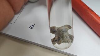 עצם ממרק עוף גרמה לדלקת ריאות חריפה