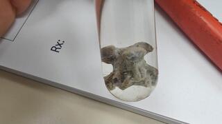 עצם ממרק עוף גרמה לדלקת ריאות חריפה