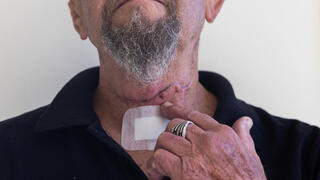 חייו של שוקי לזרוביץ ניצלו לאחר שקנה הנשימה כמעט נקטע בתאונת עבודה