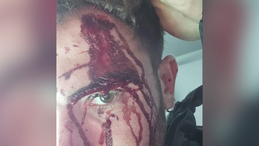 ישראלי הותקף באכזריות על ידי חבורת נפאלים בקטמנדו