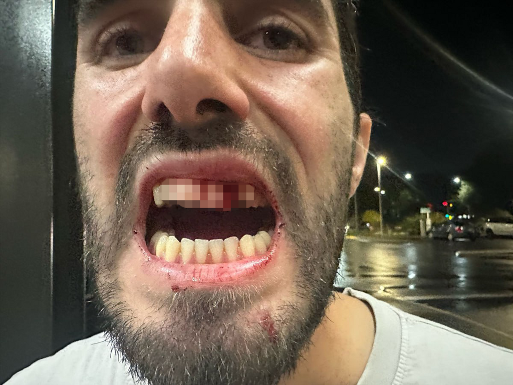 Yuval Shekel after the assault מטייל ישראלי בניו זילנד הותקף ע"י בחור מקומי