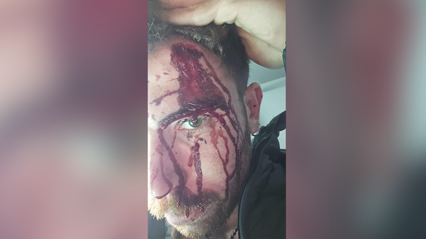 Пострадавший израильтянин Альмог Армоза ישראלי הותקף באכזריות על ידי חבורת נפאלים בקטמנדו