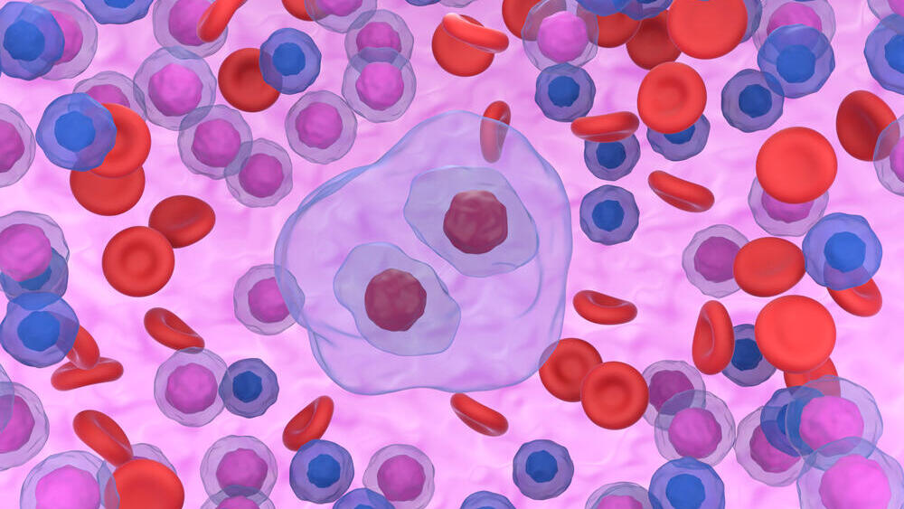 A 3D illustration of a typical Hodgkin lymphoma cell (Photo: Shutterstock) לימפומה מסוג הודג'קין