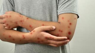 אבעבועות הקוף