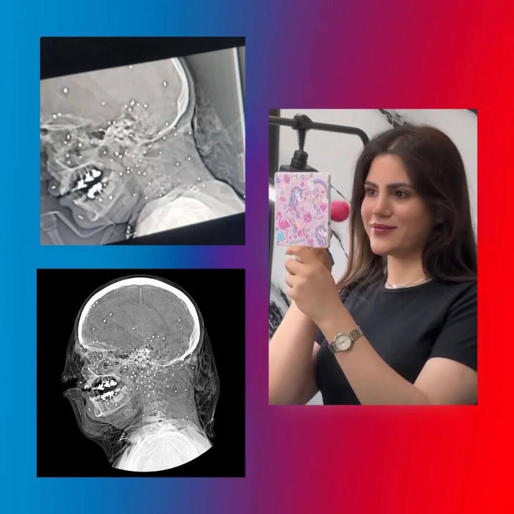 Saghar Etemadi, 22, is one of the hundreds of protesters whose face was struck by shotgun pellets and is reportedly still in a coma. She was targeted by security forces' shoygun pellets on January 4th in Farsan, western Iran, and conflicting reports have been published regarding her condition.