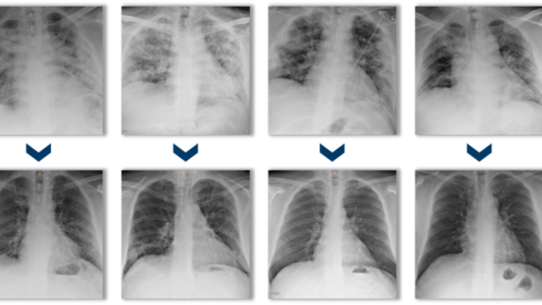 צילומי חזה של שישה מטופלים לפני טיפול במזנקיור (שורה עליונה) וכ-30 יום לאחר מכן (שורה תחתונה)