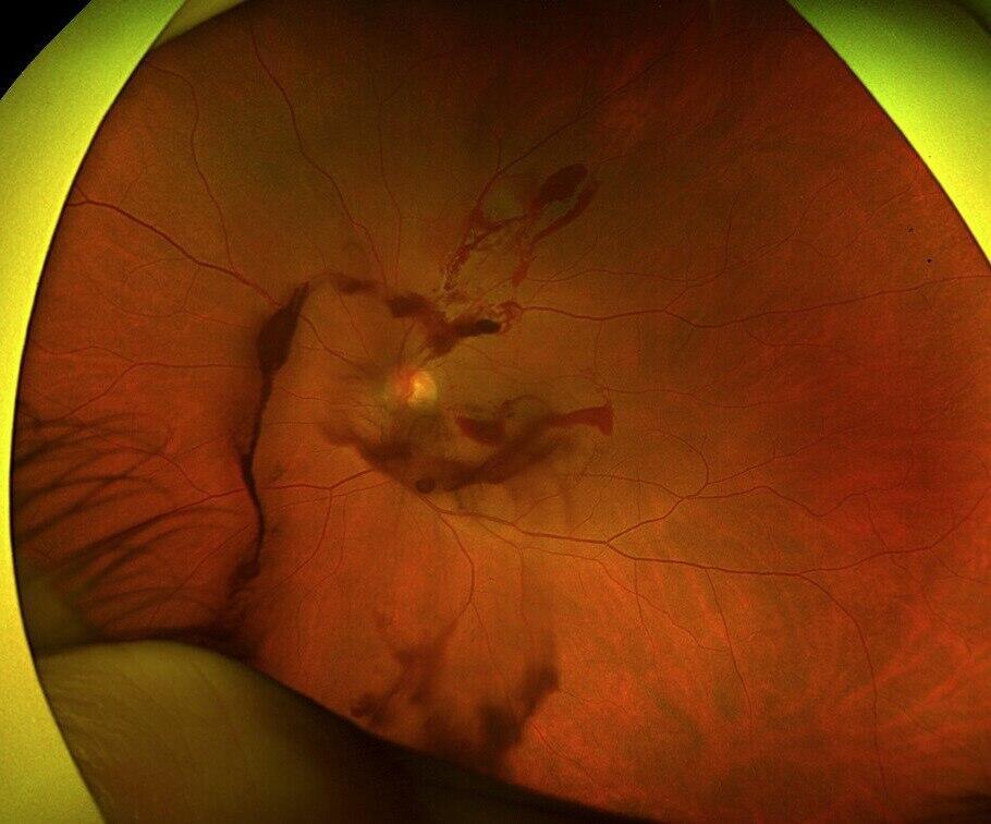 Поврежденный глаз Сильвии (Фото: пресс-служба больницы "Ихилов") העין של סילביה מרקס נפגעה במהלך דיקור סיני