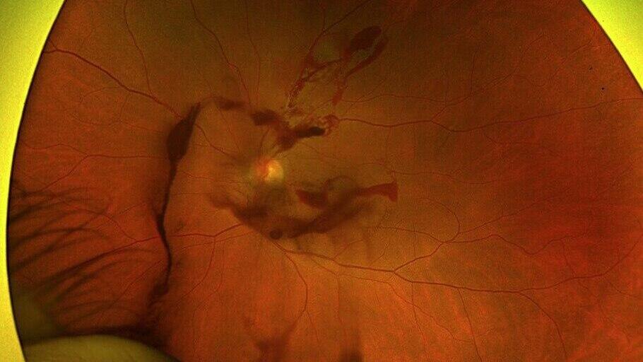 העין של סילביה מרקס נפגעה במהלך דיקור סיני