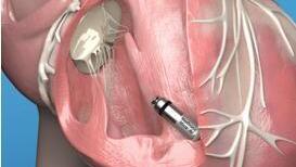 קפסולת קיצוב, המציעה את קוצב הלב הזעיר בעולם ומפחיתה את הסיכונים המובנים של קוצב הלב המסורתי