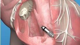 קפסולת קיצוב, המציעה את קוצב הלב הזעיר בעולם ומפחיתה את הסיכונים המובנים של קוצב הלב המסורתי