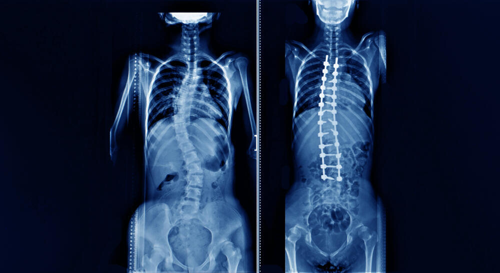 Classic scoliosis correction surgery, before and after (Photo: Shutterstock) עקמת