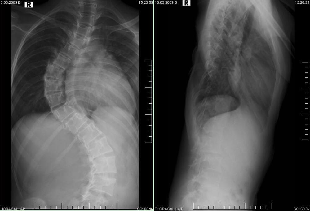 Scoliosis as seen on an X-ray (Photo: Shutterstock) עקמת
