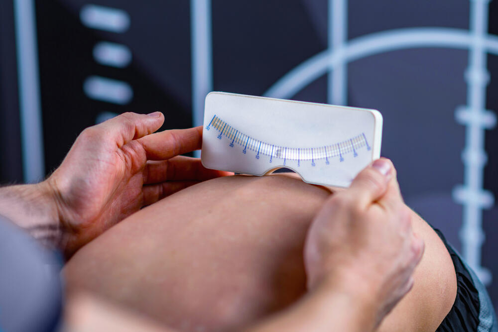 Scoliometer, a device used to screen for scoliosis (Photo: Shutterstock) עקמת בדיקה סקוליומטר