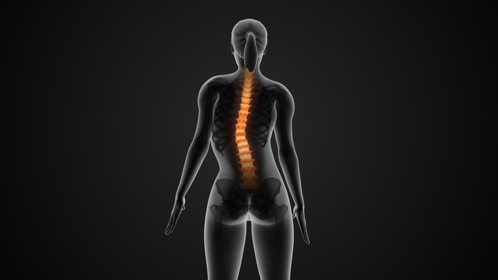 Scoliosis (Photo: Shutterstock) עקמת