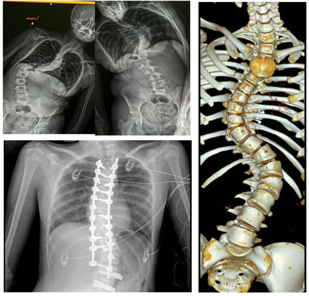 Hybrid scoliosis surgery in a 12-year-old girl (Photo: Assuta) ניתוח עקמת באסותא, ילדה בת 12