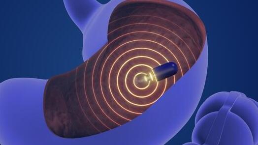 קפסולה, קיבה