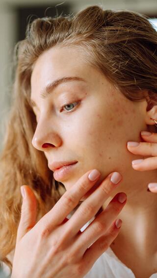 בעיות עור אקנה פיגמטציה נקבוביות פעורות