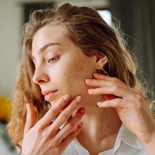 בעיות עור אקנה פיגמטציה נקבוביות פעורות