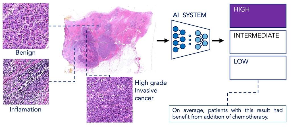 The artificial intelligence system analyzes the digital tissue sample of breast cancer taken at diagnosis : The artificial intelligence system analyzes the digital tissue sample of breast cancer taken at diagnosis