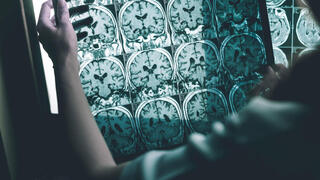 צילום הדמיה MRI של מוח עם אלצהיימר