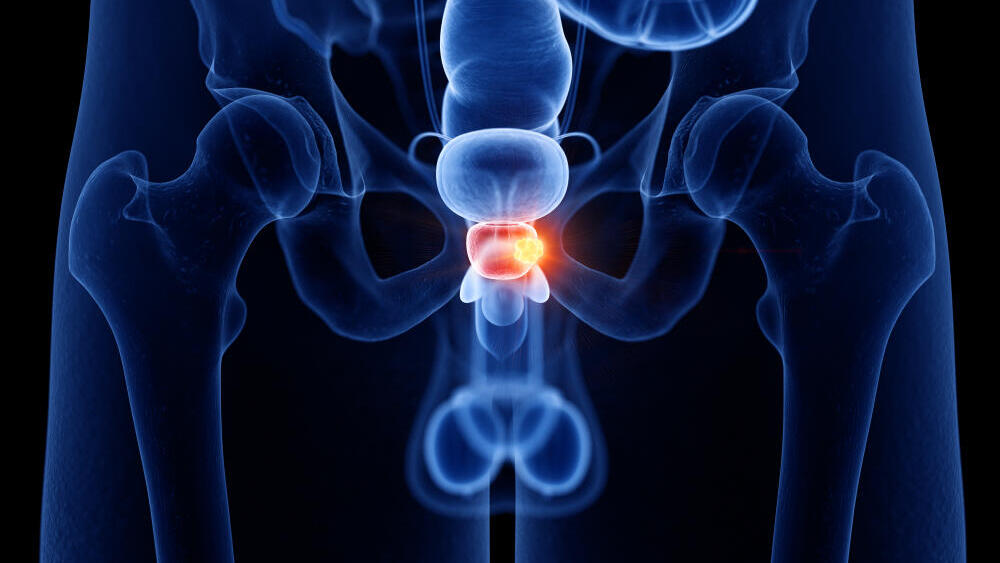 An enlarged prostate can cause urinary symptoms, including repeated nighttime trips to the bathroom (Photo: Shutterstock) ערמונית