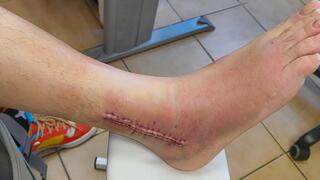 שבר בקרסול צבי דובוש פוסט פייסבוק