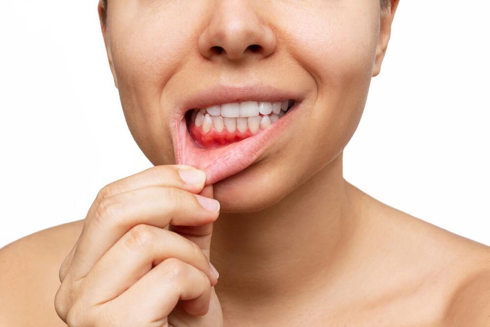 Bleeding gums: An early sign of active inflammation that should not be ignored (Photo: Shutterstock) חניכיים
