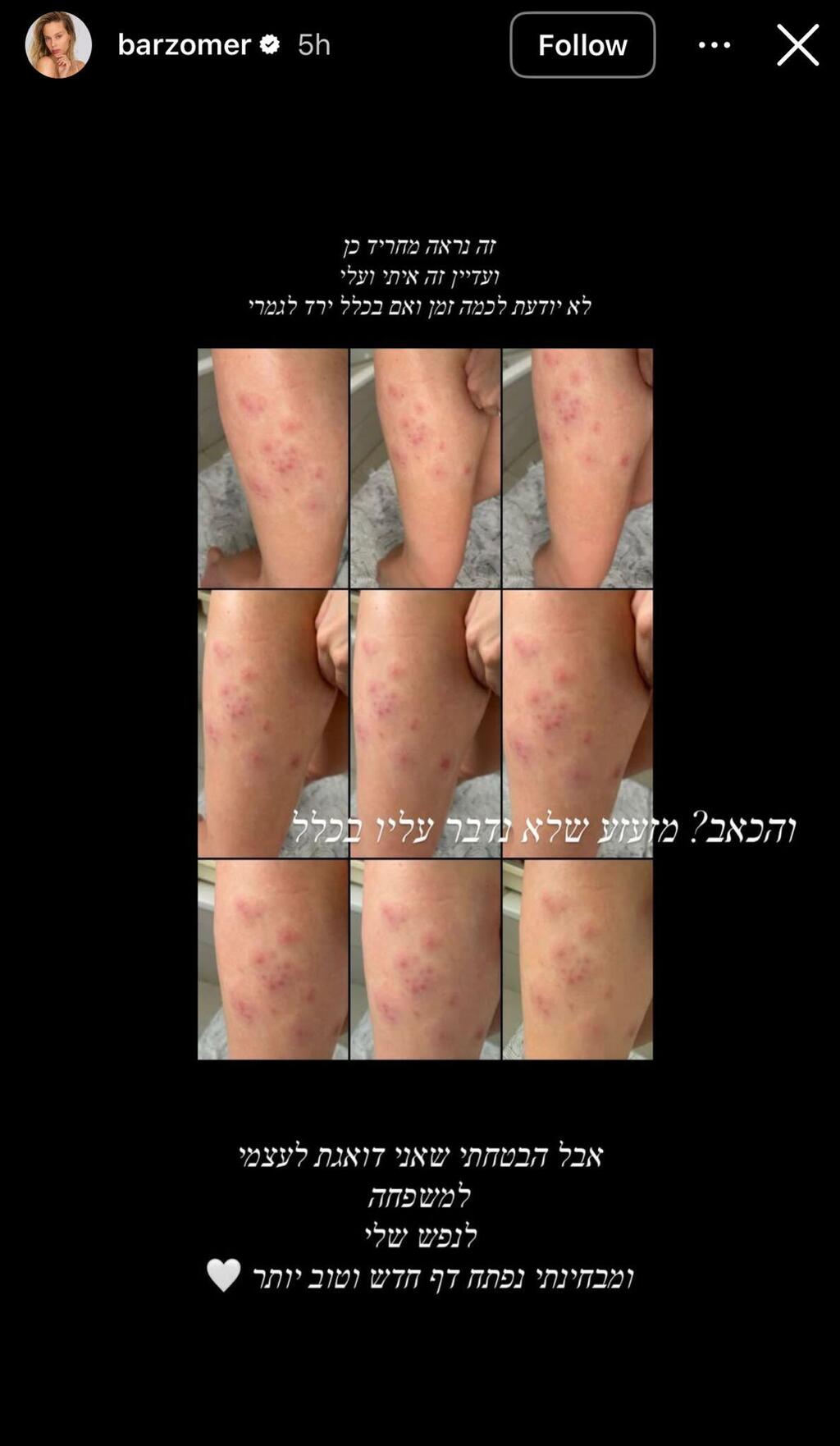 בר זומר משתפת שחלתה בשבקת חוגרת