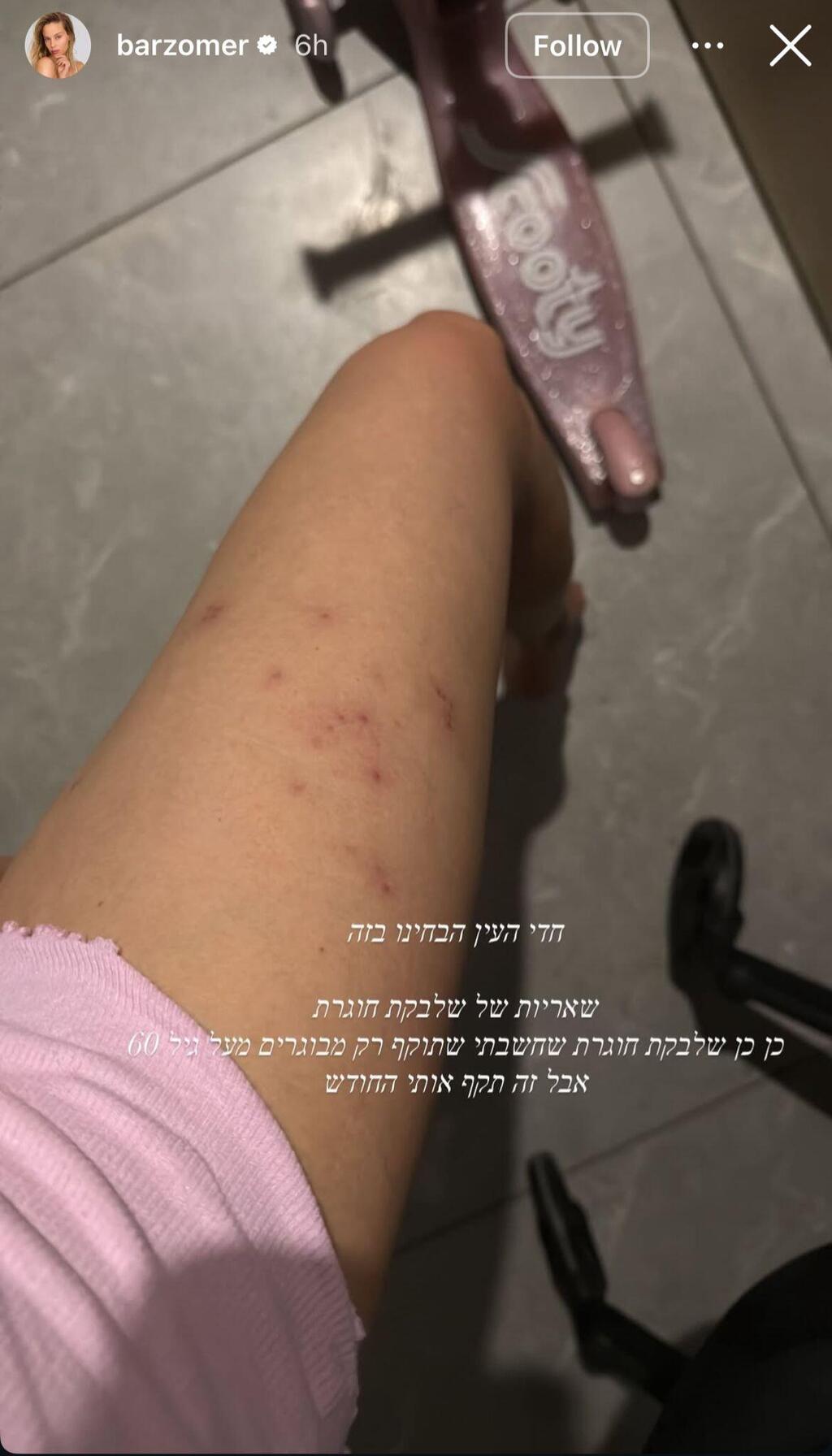 בר זומר משתפת שחלתה בשבקת חוגרת